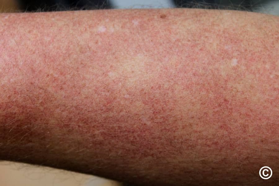 Fine red dots and diffuse redness on limb skin, typical of capillaritis or small-vessel inflammation.