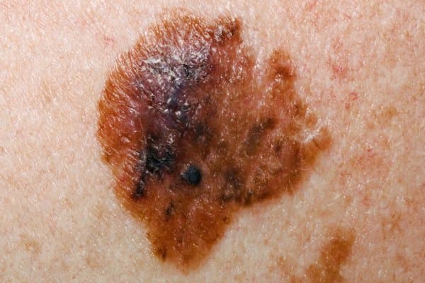 Large asymmetric brown-black skin lesion with irregular borders and uneven colour, suspicious for melanoma