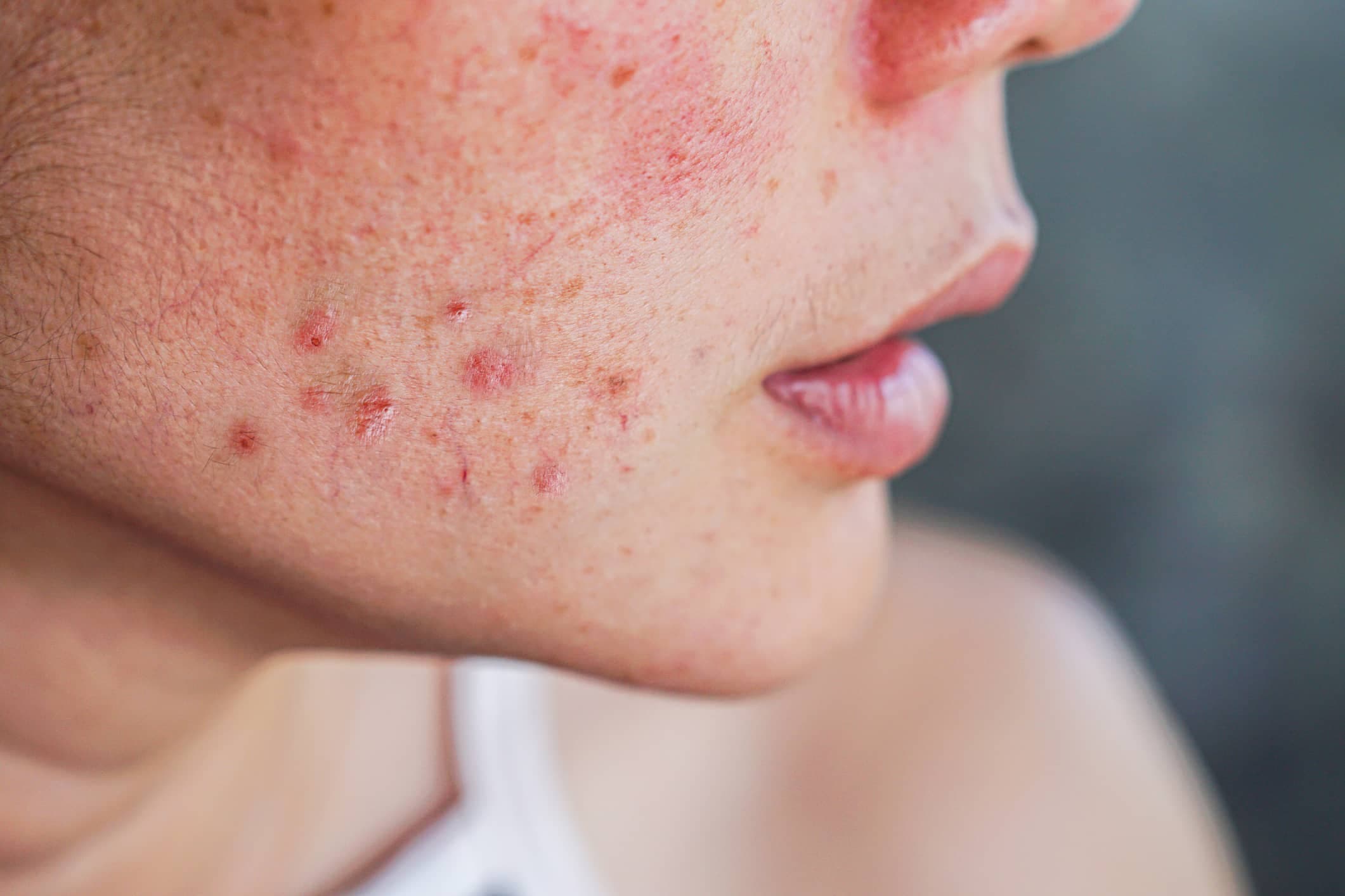 Close-up of the lower face with acne, redness and blemishes on the cheek and chin, suggesting hormonal acne.