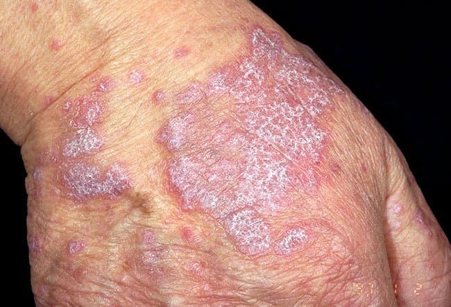 Back of the hand with scaly, pinkish raised plaques characteristic of lichen planus.