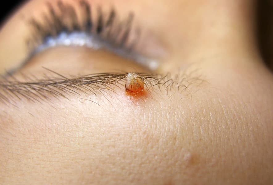 Small skin papilloma with traces of blood located beside the eyebrow near the eye.