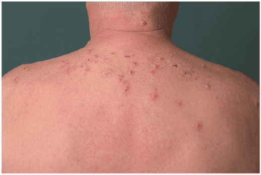 Scratched itchy nodules and excoriations scattered across the back, characteristic of nodular prurigo.