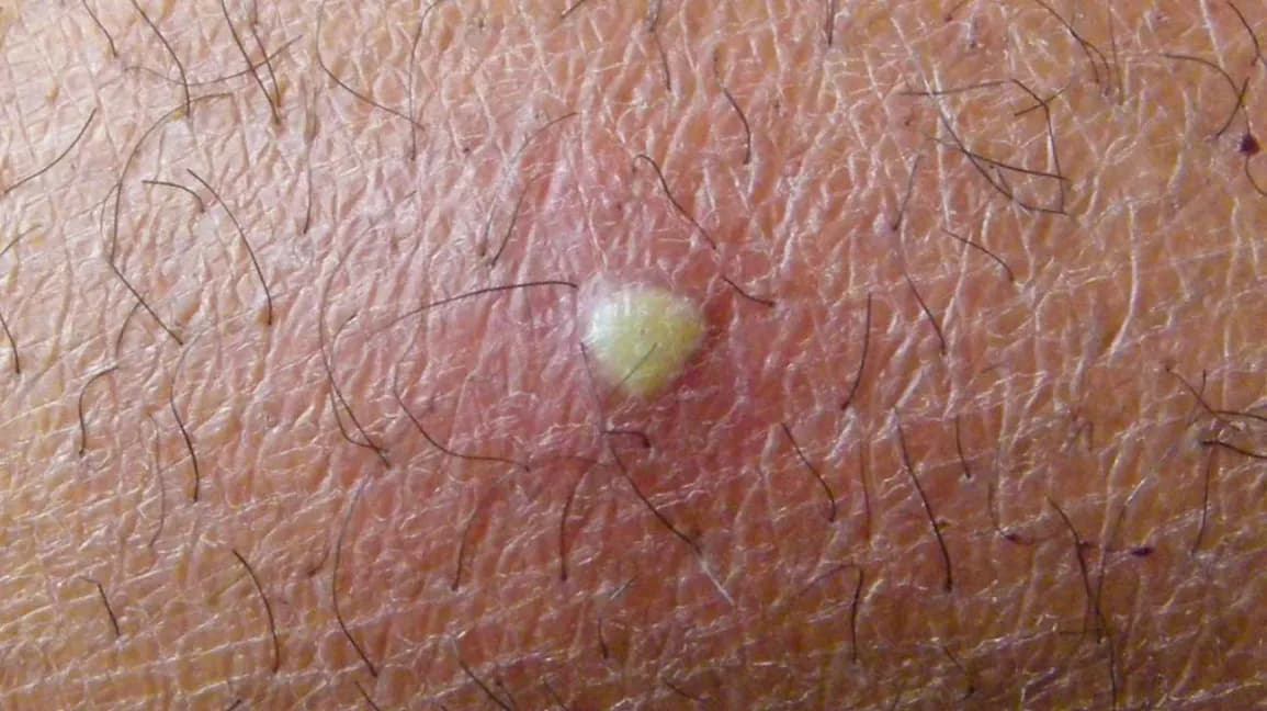 Furuncle with a yellowish pus-filled head and red surrounding skin in a hairy area, reviewed by a dermatologist.