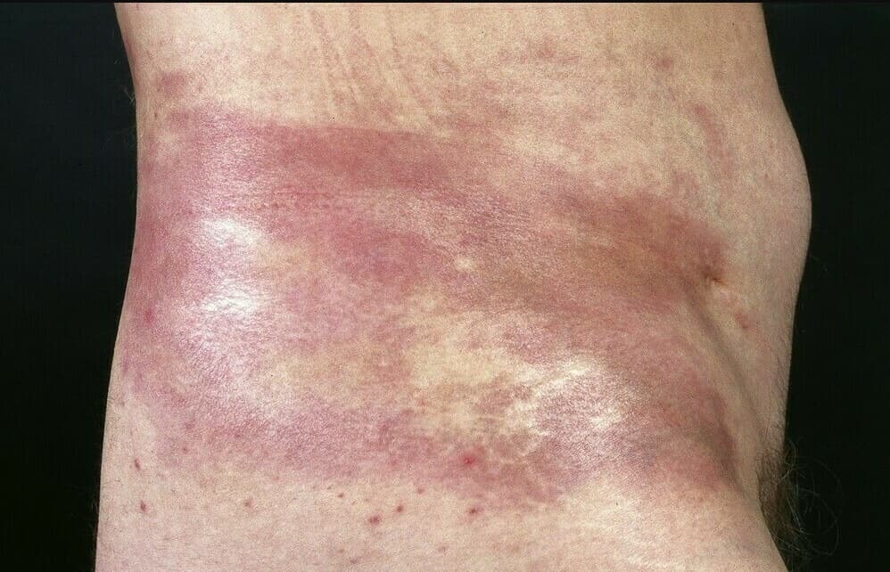 Broad violet-red, hardened skin areas on the torso showing the inflammatory phase of localized scleroderma.