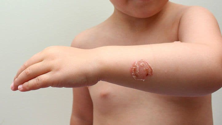 Blistered impetigo lesion with a yellowish crust on a child's forearm skin