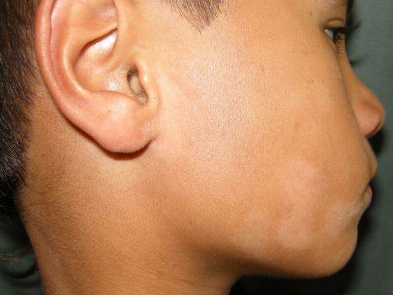 Pityriasis alba lapse põsel Hele hüpopigmenteerunud laik lapse põsel, iseloomulik pityriasis alba'le.